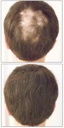 alopecia-areata-2